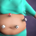 Using Bariatric Tables for Weight Loss: A Comprehensive Guide