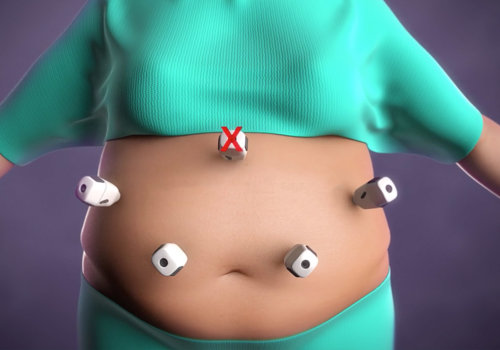 Using Bariatric Tables for Weight Loss: A Comprehensive Guide